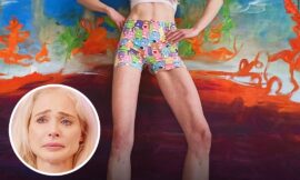 Woman Who Paid $161,000 To Extend Her Legs By 5.5 Inches Left With Huge Regrets