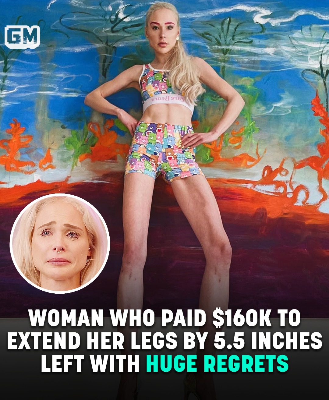 Read more about the article Woman Who Paid $161,000 To Extend Her Legs By 5.5 Inches Left With Huge Regrets