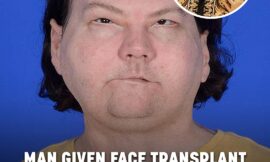 Man Given Face Transplant After Horror Accident Shares Beautiful Photo With His New Wife