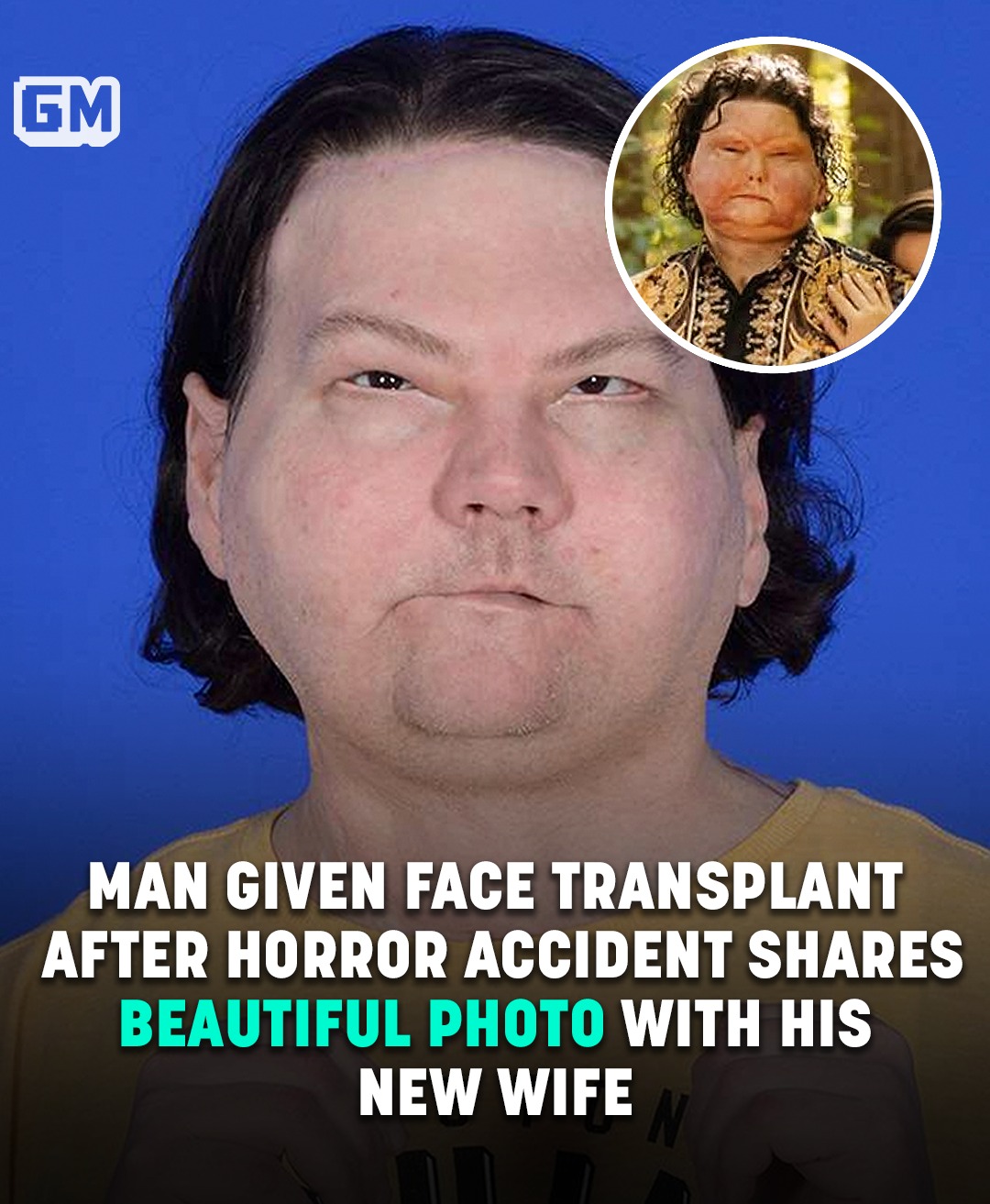 Read more about the article Man Given Face Transplant After Horror Accident Shares Beautiful Photo With His New Wife