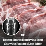 Doctor shares horrifying scan showing patient’s legs after eating undercooked pork